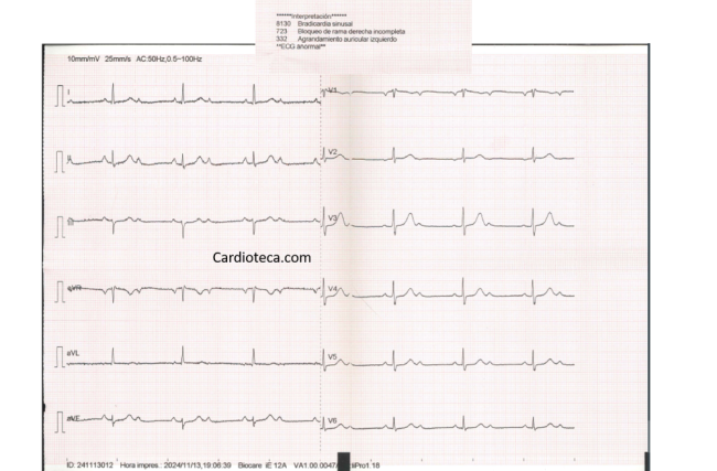 ECG