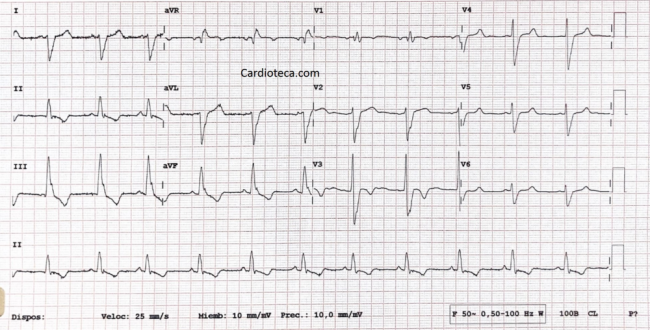 ECG 2 Mayo 2022
