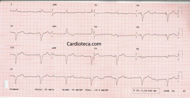 ECG