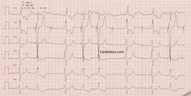 ECG