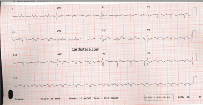 ECG