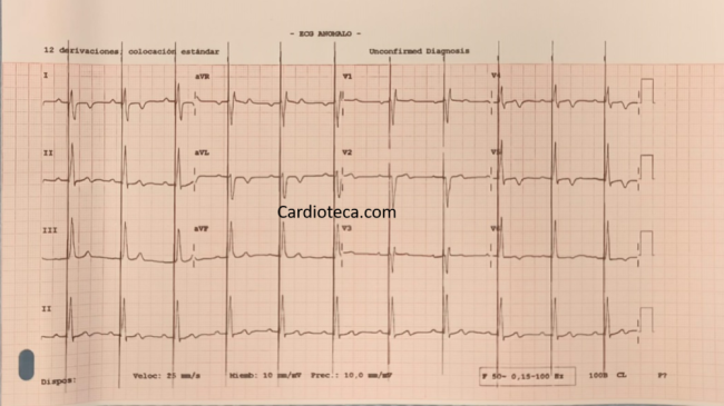 ECG