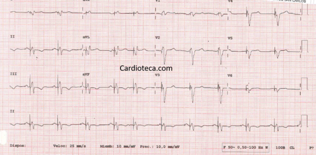 ECG