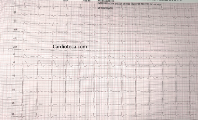 ECG