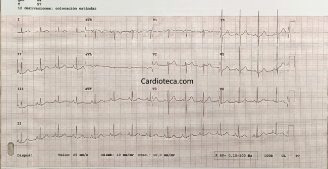 ECG