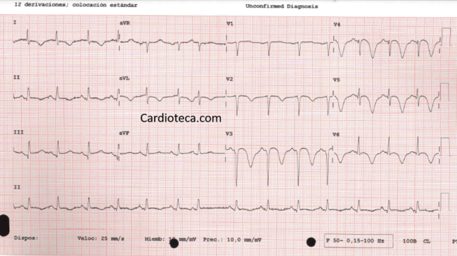 ECG