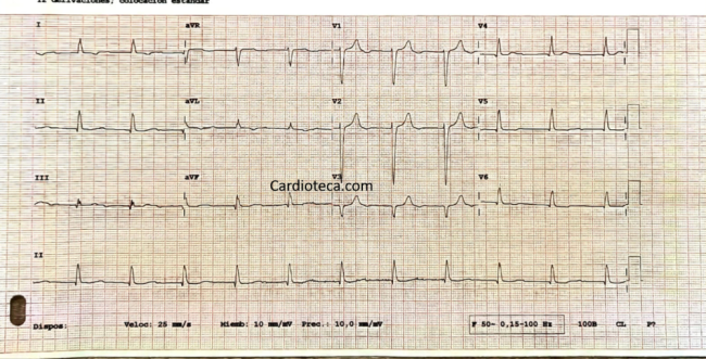 ECG