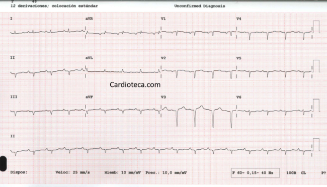 ECG