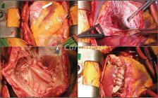 Endoventriculoplastia de Dor