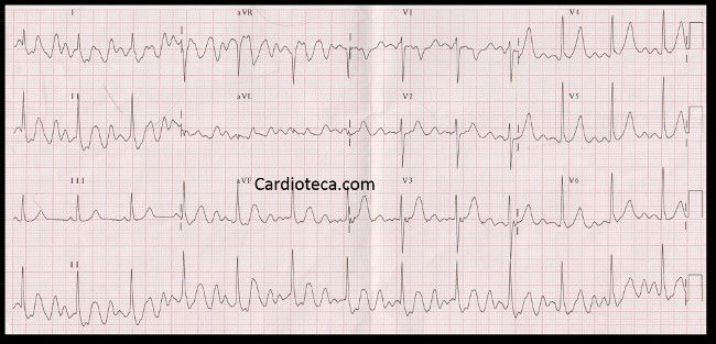 Esta imagen representa el electrocardiograma del caso