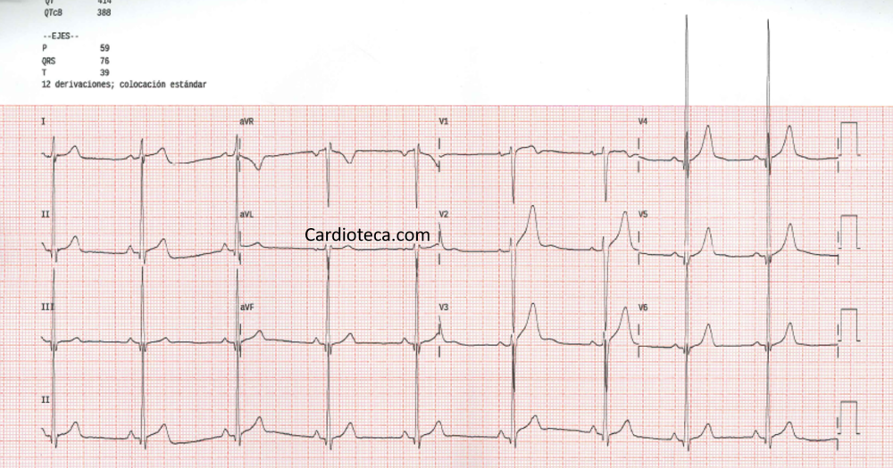 ECG 4 mayo 2026