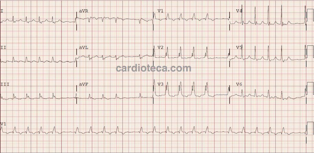 Esta imagen representa el electrocardiograma del caso