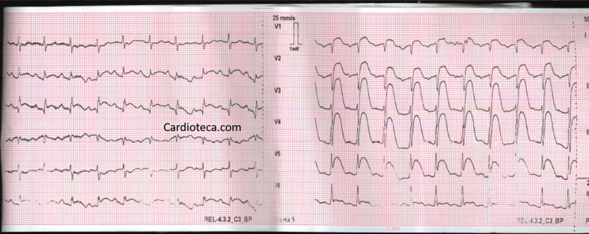 Infarto agudo de miocardio de cara anterior extenso