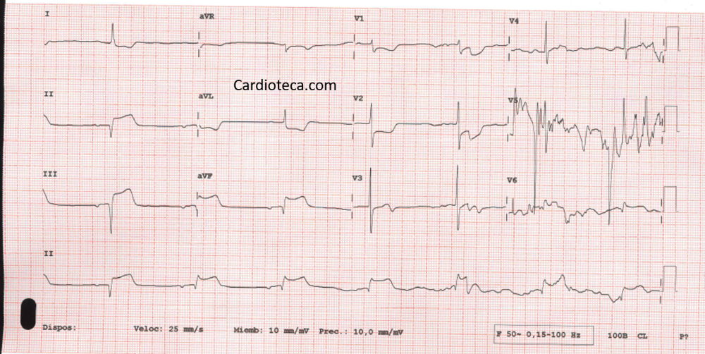 ecg