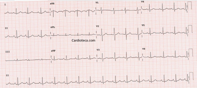 Esta imagen representa el electrocardiograma del caso