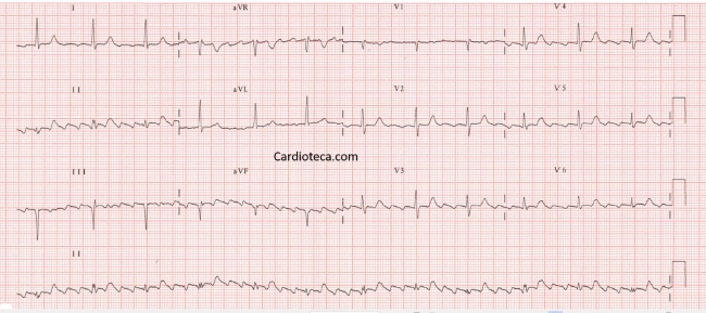 Esta imagen representa el electrocardiograma del caso