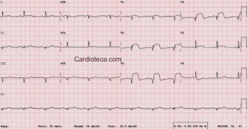 Esta imagen representa el electrocardiograma del caso