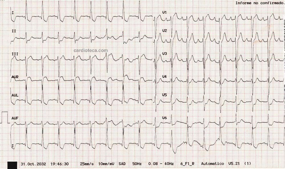 Esta imagen representa el electrocardiograma del caso