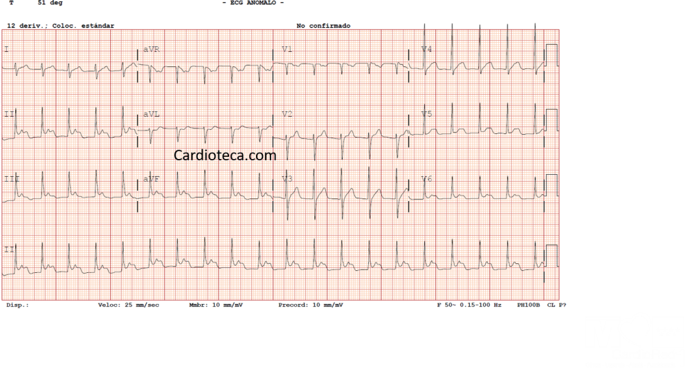 ecg