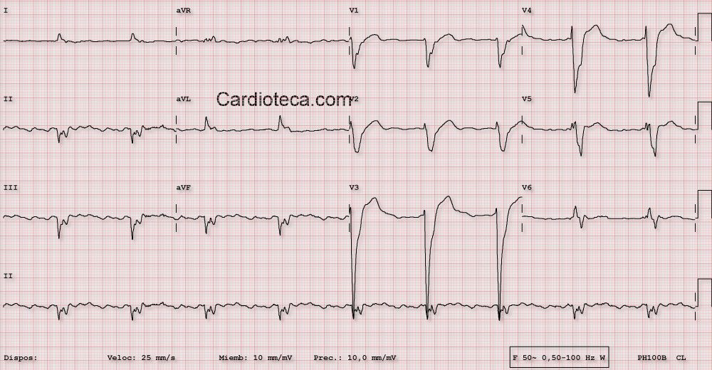 ECG 13 Enero 2014