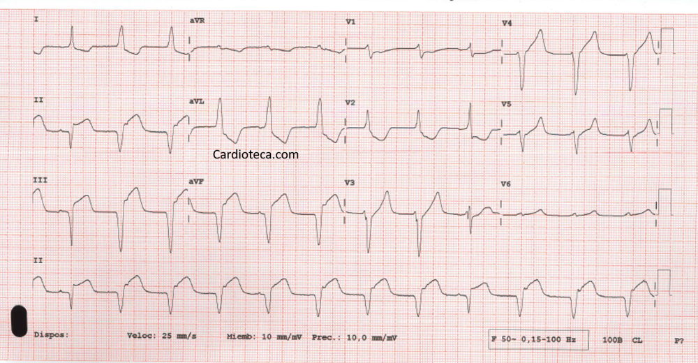 ECG 13 abril 2026