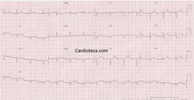 Esta imagen representa el electrocardiograma del caso