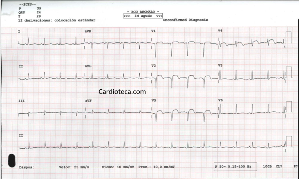 ecg