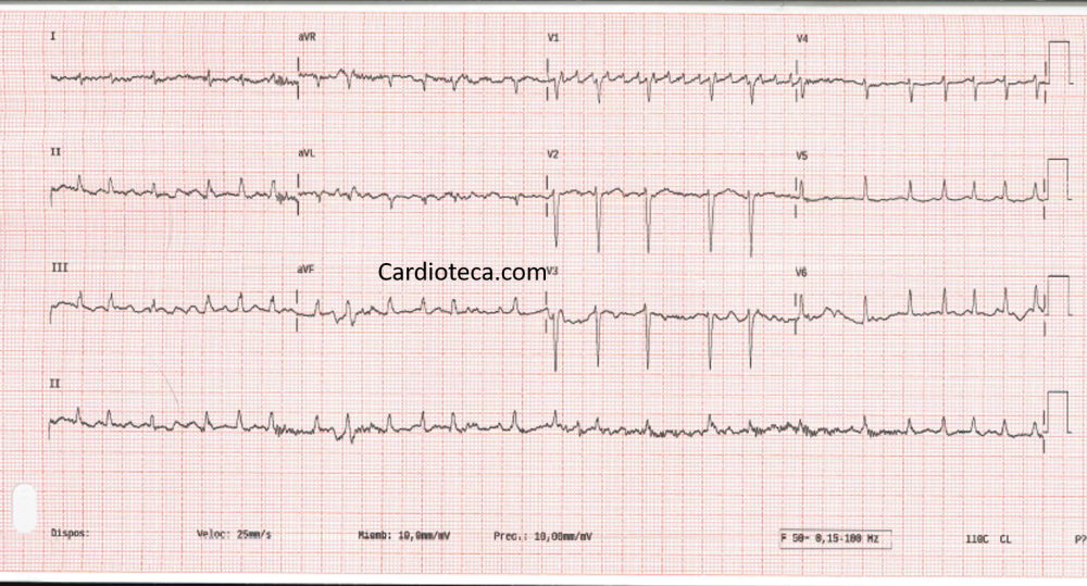 ECG 16 febrero 2026