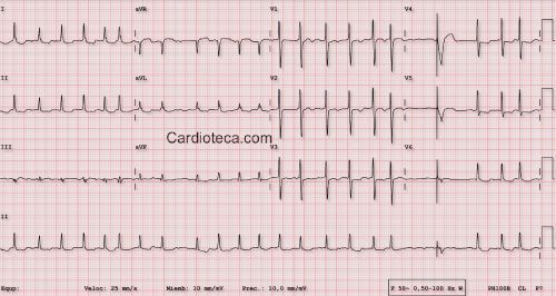 Esta imagen representa el electrocardiograma del caso