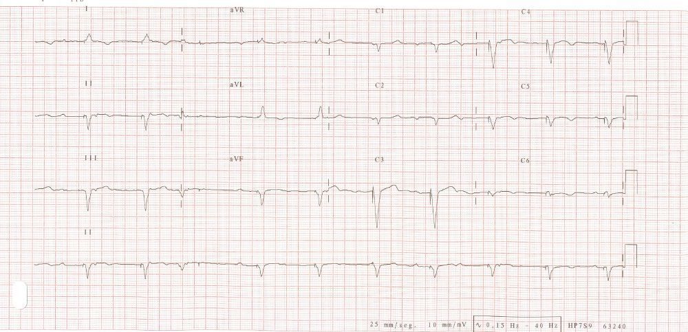 Esta imagen representa el electrocardiograma del caso