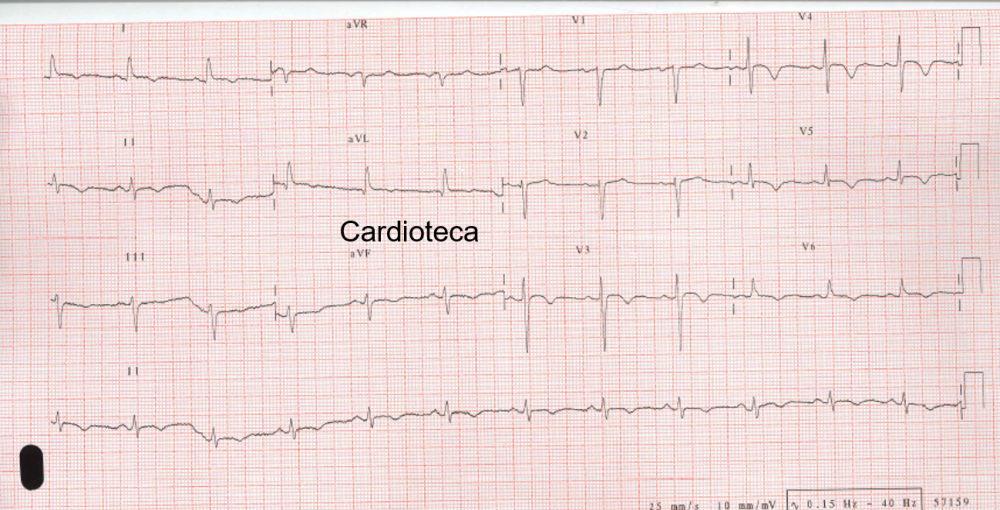ecg