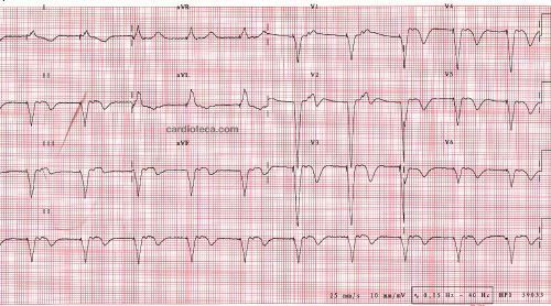 Esta imagen representa el electrocardiograma del caso