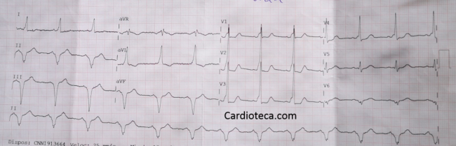 Esta imagen representa el electrocardiograma del caso