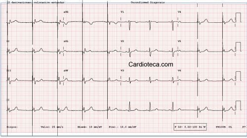 Esta imagen representa el electrocardiograma del caso