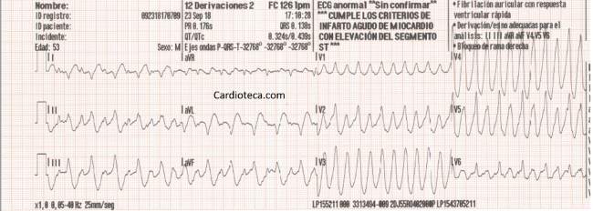Esta imagen representa el electrocardiograma del caso