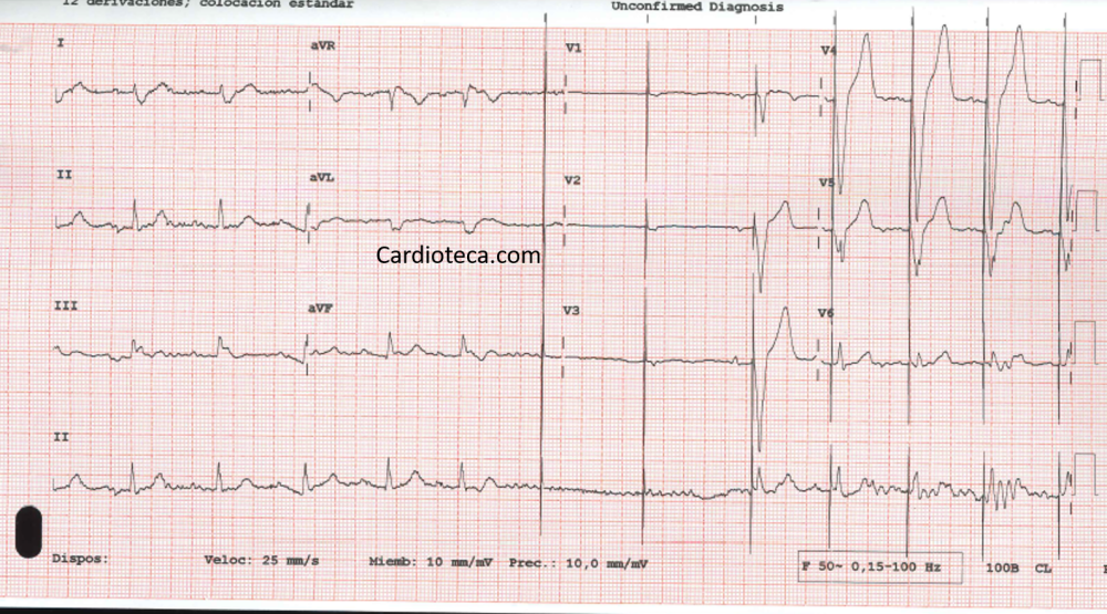 ECG 20 abril 2026