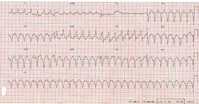 Esta imagen representa el electrocardiograma del caso