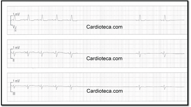 Esta imagen representa el electrocardiograma del caso