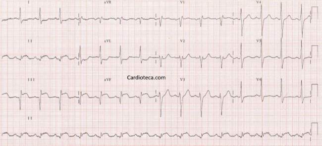 Infarto agudo de miocardio de cara inferior por oclusión de la arteria coronaria derecha