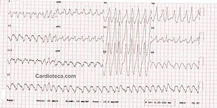 Esta imagen representa el electrocardiograma del caso