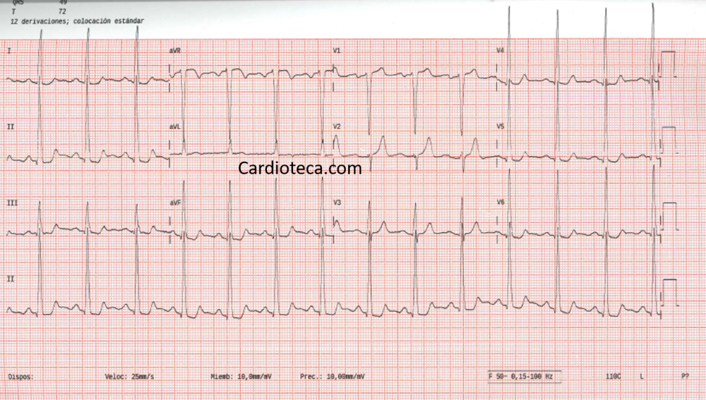 ¿Cómo oriento el caso a raíz de este ECG?