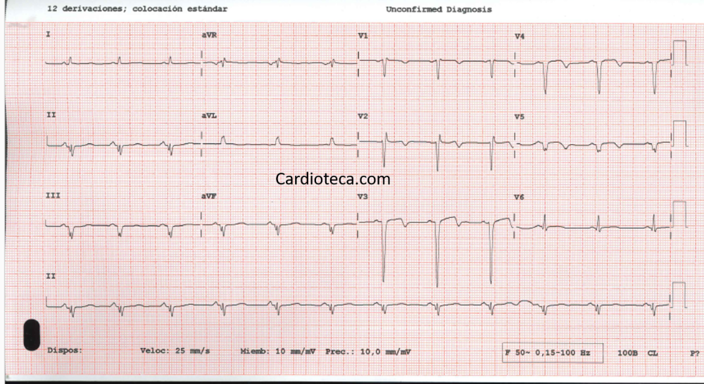 ECG 25 mayo 2026
