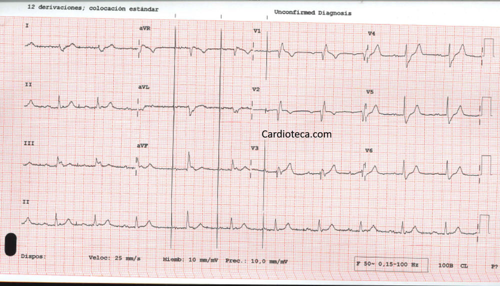 ECG 27 abril 2026