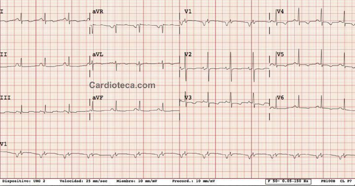 Esta imagen representa el electrocardiograma del caso
