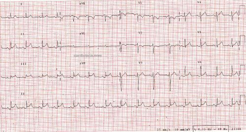Esta imagen representa el electrocardiograma del caso
