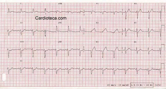 Esta imagen representa el electrocardiograma del caso