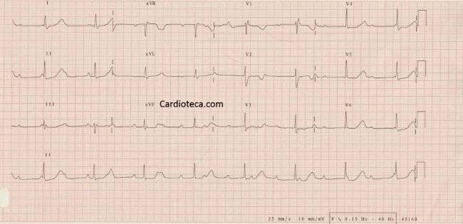 Esta imagen representa el electrocardiograma del caso