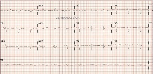 Esta imagen representa el electrocardiograma del caso