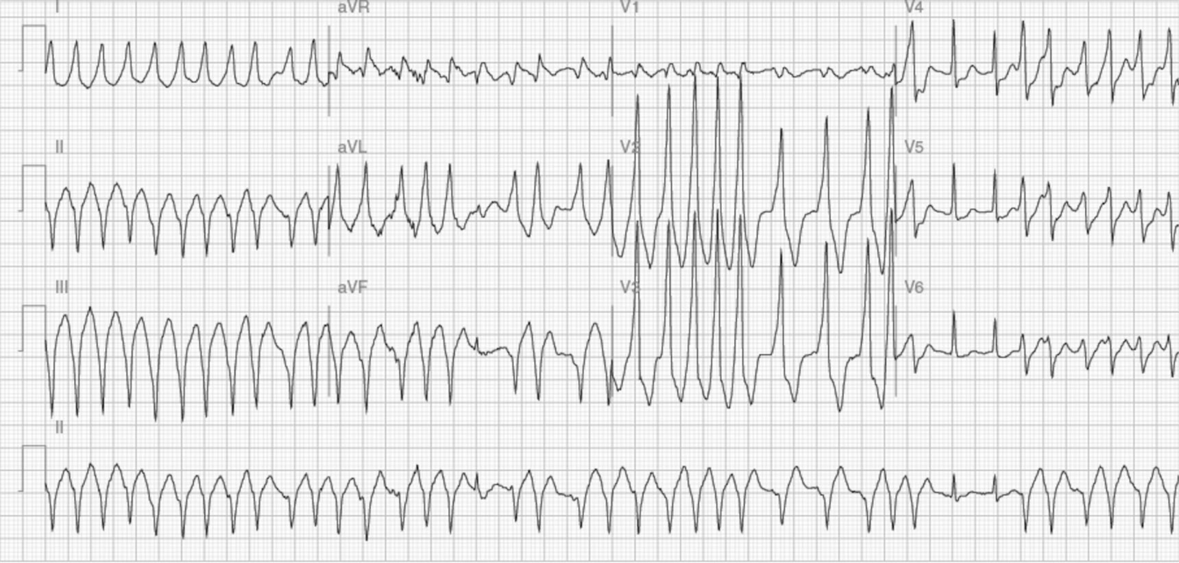 ECG de la pregunta 7 del examen MIR 2016 (convocatoria 2015): taquicardia irregular de QRS ancho con complejos cambiantes, fibrilación auricular preexcitada