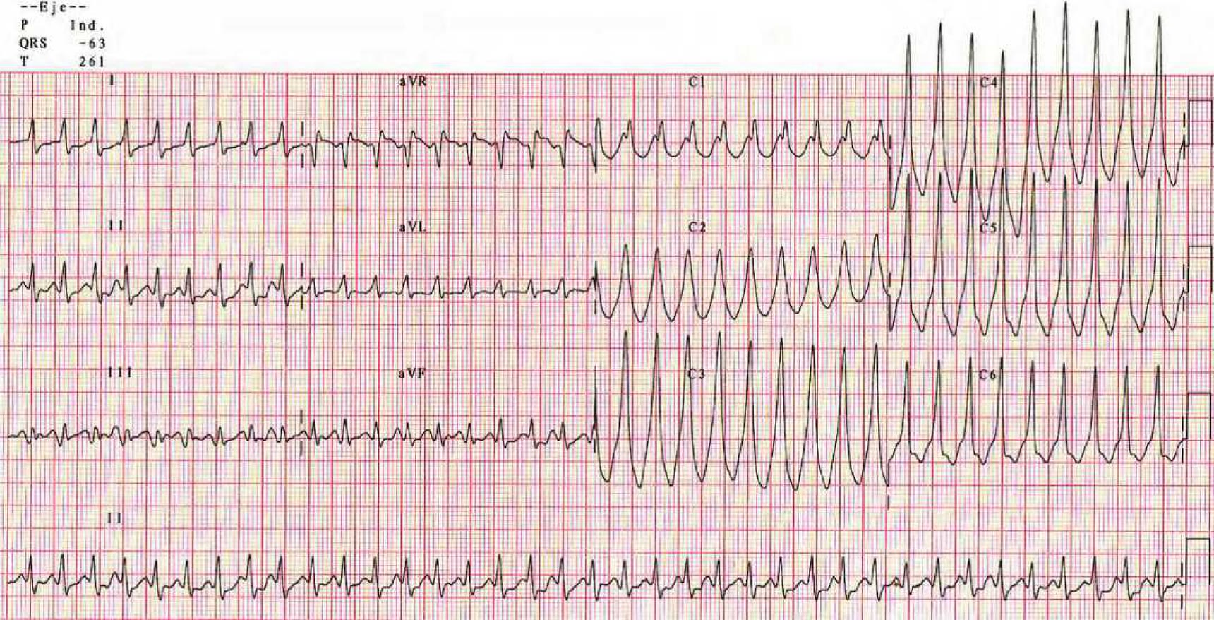 ECG de la pregunta 6 del examen MIR 2017 (convocatoria 2016): taquicardia regular de QRS ancho en un paciente con infarto previo, taquicardia ventricular